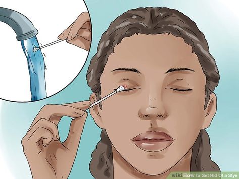 Eye Pimple How To Get Rid, Get Rid Of A Stye Overnight, Stye Remedies Fast How To Get Rid At Home, How To Get Rid Of Stye Eye, Sty Eye Remedies How To Get Rid, Home Remedy For Stye Eye, How To Treat A Stye In Your Eye, How To Get Rid Of Stye Eye Overnight, How To Heal A Stye Fast