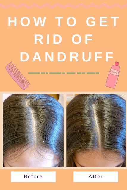 How To Get Rid Off Dandruff, How To Get Rid Of Bad Dandruff, How To Remove Dandruff From Scalp Quick, Natural Ways To Get Rid Of Dandruff, How To Deal With Dandruff, How To Fix Dandruff, Ways To Get Rid Of Dandruff, Best Dandruff Remedy, How To Get Dandruff Out Of Hair