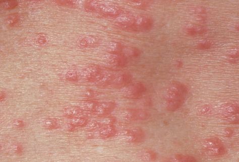 Pictures of STDs: Herpes, Genital Warts, Gonorrhea, STD Symptoms ... Common Skin Rashes, Itchy Rash, Home Remedies For Skin, Acne Causes, Skin Diseases, Skin Problems, Home Remedies, Beauty Tips, Acne