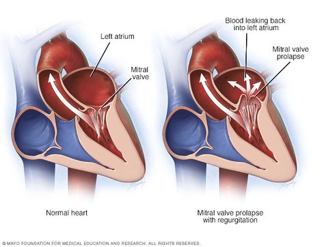 Mitral Valve Regurgitation, Tricuspid Valve, Polycystic Kidneys, Heart Surgeon, Mitral Valve, Heart Valves, Congenital Heart, Atrial Fibrillation, Disease Symptoms