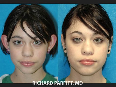 Otoplasty performed by Dr. Parfitt of Madison WI Ear Pinning Surgery, Ear Surgery, Plastic Surgery Photos, Facial Anatomy, Facial Plastic Surgery, Reconstructive Surgery, Facial Plastic, Surgery Center, Cosmetic Procedures