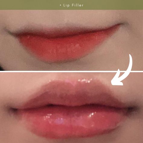 Korean Skincare, Skin Treatments, Korean Lip Filler Before And After, Korean Lip Filler, Korean Lips, Cherry Lips, Skin Clinic, Lip Fillers, Plastic Surgery