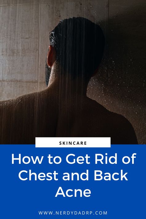 If you suffer from chest or back acne, then this article will help you understand what causes it. It also gives simple steps that can help! How to Get Rid of Chest and Back Acne Chest And Back Acne, Remedies For Back Acne, Back Acne Remedies, Chest Acne, Blind Pimple, Back Acne, Pimples Under The Skin, Prevent Pimples, Acne Facial