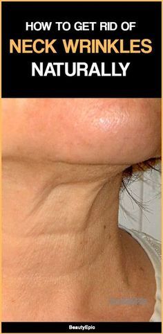 Tighten Neck Skin, Saggy Neck, Skin Tightening Stomach, Wrinkle Remedies, Tighten Loose Skin, Neck Wrinkles, Skin Care Wrinkles, Face Wrinkles, Saggy Skin