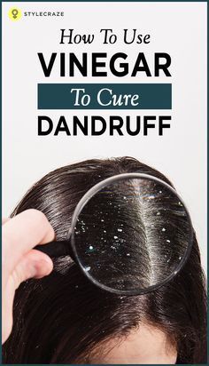 Bad Dandruff, Severe Dandruff, How To Treat Dandruff, Dandruff Remedy, Dandruff Treatment, Flaky Scalp, Hair Dandruff, Baking Soda Shampoo, Hair Remedies