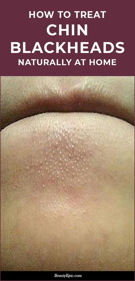 How to Treat Chin Blackheads Naturally at Home? Chin Blackheads, Black Head Remover Mask, Rid Of Blackheads, Home Remedy For Cough, Types Of Acne, Get Rid Of Blackheads, Natural Cough Remedies, Cold Home Remedies, Lose 40 Pounds