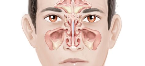 What is sinus? Sinuses are cavities usually filled with air located around forehead, eyes and cheeks. Read Causes and 5 quick steps to treat sinus in no time! Ear Congestion, Paranasal Sinuses, Sinus Cavities, Chronic Sinusitis, Nasal Septum, Ent Doctor, Sinus Pain, Loss Of Balance, Upper Respiratory Infection