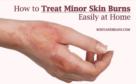 Wondering about how to treat minor skin burns at home? Here’s the list of 14 home remedies that will help you in treating minor skin burns easily. Remedies For Burns Skin, Fire Burns On Skin, Burn Scar Remedies, Burn Relief Skin, Burned Skin Remedies, Remedies For Burns, Home Remedies For Burns, Burn Remedy, Burn Relief