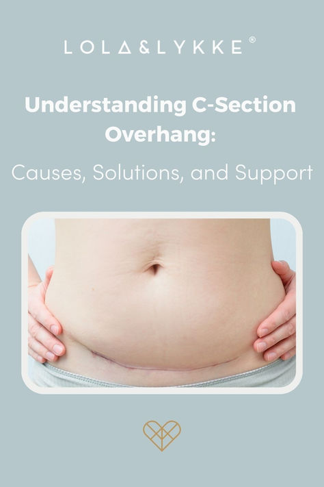 You’ve just had a c-section and now your tummy is hanging over your scar. Why? We’re going to explore the causes of c-section overhang and how mums can treat their c-section shelf and scar through a variety of methods so you can get back to feeling more yourself postpartum🤍 Get Rid Of C Section Pouch, C Section Belly Get Rid Of, C Section Overhang Belly, C Section Shelf Get Rid Of, C Section Massage, C Section Scar Healing, C Section Scar Massage, C Section Shelf, Belly After C Section