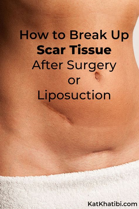 How To Break Up Scar Tissue After Surgery or Liposuction - Kat Khatibi Podcast and Wellness Blog [Health - Happiness - Beauty] Scar Tissue Removal, Scar Tissue Massage, Plastic Surgery Recovery, Scar Massage, How To Break Up, Oils For Scars, C Section Scars, Plastic Surgery Procedures, Scar Removal