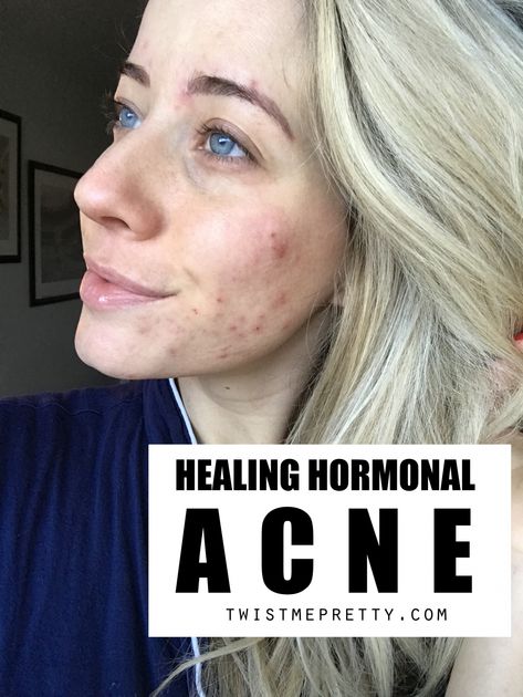 How To Clear Up Hormonal Acne + My Journey - Twist Me Pretty Cystic Hormonal Acne, How To Help Hormonal Acne, How To Clear Up Acne, Hormone Acne, Postpartum Acne, Hormonal Acne Skincare Routine, Medical Remedies, Hormonal Acne Supplements, Hormonal Acne Remedies