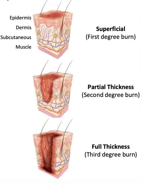 Burns are characterized, based on the depth of tissue damage and skin response, as superficial (first degree), partial thickness (second degree), or full-thickness (third-degree). Superficial burns result in only minor tissue damage to the... Burns On Skin, First Degree Burn, Second Degree Burn, Advanced Emt, Third Degree Burn, Emt Notes, Burns Nursing, Types Of Burns, 2nd Degree Burns