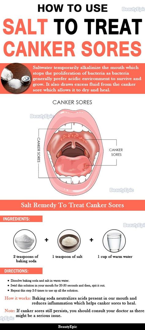 how to use salt to treat canker sores Canker Sore, Stronger Teeth, Oral Care Routine, Gum Care, Receding Gums, Cold Sore, Oral Health Care, Tooth Decay, Oral Health