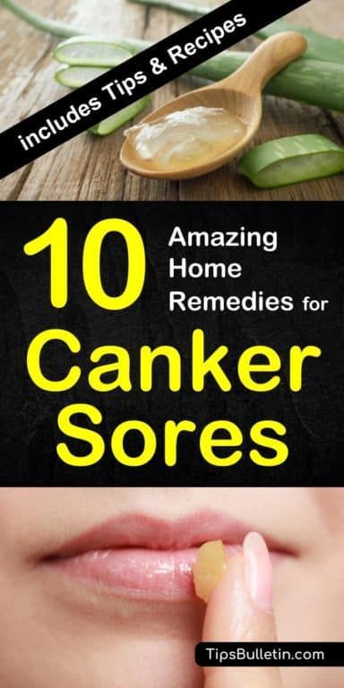 How To Heal A Canker Sore Fast, How To Get Rid Of Sores In Your Mouth, How To Get Rid Of Canker Sore In Mouth, Mouth Sore Remedy How To Get Rid, Canker Sore Remedy Overnight, Sores On Tongue, Sores In Mouth, Cold Sore Remedy Fast, Canker Sore On Tongue