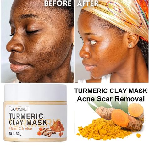 Turmeric Vitamin C Face Mask Acne Dark Spots Removal Exfoliating Oil Control Deep Cleansing Clay Dark Spots Removal, Face Mask Acne, Vitamin C Face Mask, Mask Acne, Turmeric Vitamins, Acne Dark Spots, Acne Face Mask, Acne Scar Removal, Foaming Face Wash