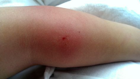 This is why some insect bites swell up - CosmopolitanUK Bug Bite Swelling, Spider Bite Symptoms, Insect Bite, Spider Venom, Bug Bite, Spider Bites, Bug Bites, Classy Photography, Insect Bites