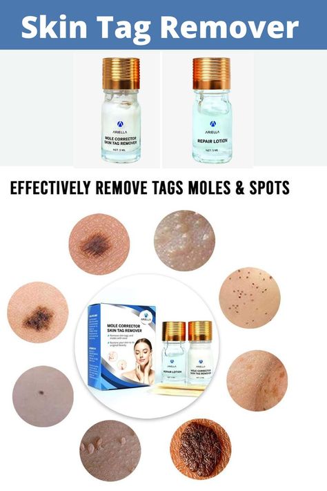 Remove Moles, Coldsore Remedies Quick, Remove Skin Tags Naturally, Tag Remover, Losing 40 Pounds, Skin Natural Remedies, Cold Sores Remedies, Natural Sleep Remedies, Natural Cold Remedies