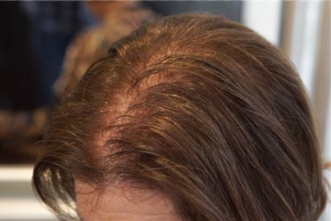 As they age, women lose their hair, too. Which treatments really work? Losing Hair Women, Lost Hair, Work Hairstyles, Thinning Hair, Short Hair Cuts For Women, Down Hairstyles, Hair Looks, Short Hair Cuts, Thick Hair Styles