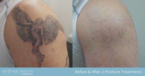 PicoSure Tattoo Removal Case Study & Interview #5 – Andy F https://www.andreacatton.co.uk/2018/01/video-picosure-tattoo-removal-case-study-interview-5-andy-f/ Picosure Tattoo Removal, Skin Laser, Laser Skin, Tattoo Removal, After Photos, Case Study, Interview, Tattoos, Skin