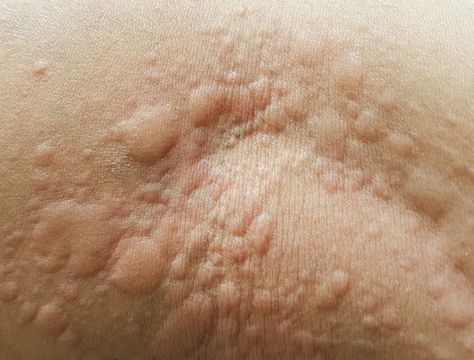 What are hives, the common skin condition that gives you itchy, red bumps? Skin Irritation Remedies, Skin Rash Remedies, Body Infection, Itchy Skin Rash, Rashes Remedies, Allergy Remedies, Viral Infection, Skin Condition, Skin Allergies