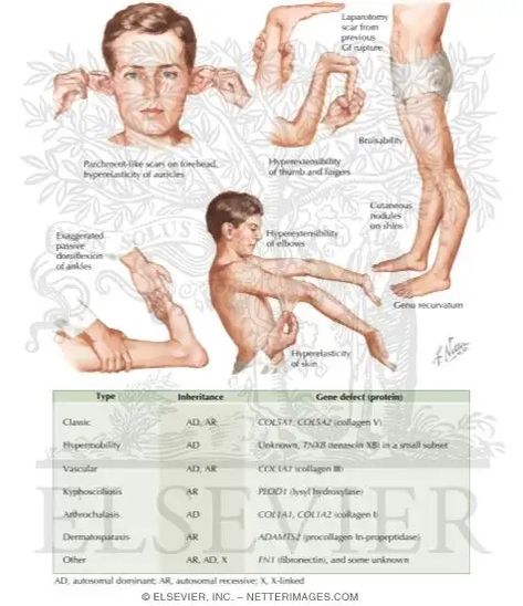 The Four Main Forms of Ehlers-Danlos Syndrome - HubPages Blue Sclera, Ehlers Danlos Syndrome Types, Broad Nose, Elhers Danlos Syndrome, Ehlers Danlos Syndrome Hypermobility, Scleroderma Awareness, Rectal Prolapse, Medical Artwork, Ehlers Danlos Syndrome Awareness