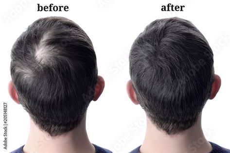 Stock Image: Men'shair after using cosmetic powder for hair thickening. Before and after Regrow Hair Naturally, Rapid Hair Growth, Dunner Wordend Haar, Hair Vitamins, Hair Thickening, Hair Regrowth, Hair Restoration, Hair Transplant, Hair Growth Oil