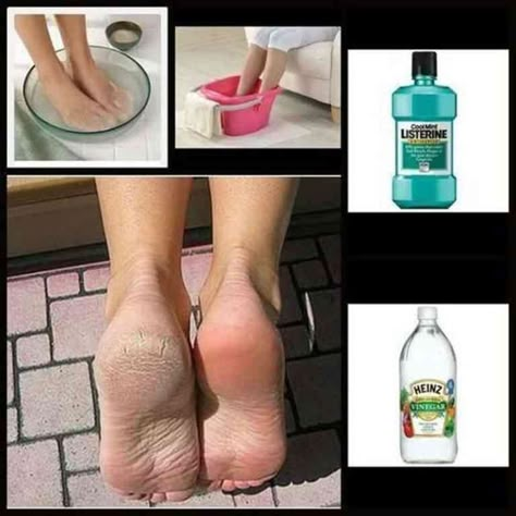 Heal Cracked Heels, Foot Soak Recipe, Antiseptic Mouthwash, Bolesti Chrbta, Foot Soak, Beauty Remedies, Mouthwash, Health And Beauty Tips, Cleaning Products