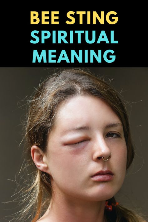 What is the spiritual meaning of bee sting? How To Treat A Bee Sting, Bee Spiritual Meaning, Bee Sting Swelling, Bee Sting Remedy, Bee Sting Relief, Spiritual Meaning Of Bees, Wasp Sting, Remedies For Bee Stings, Spiritual Awakening Stages