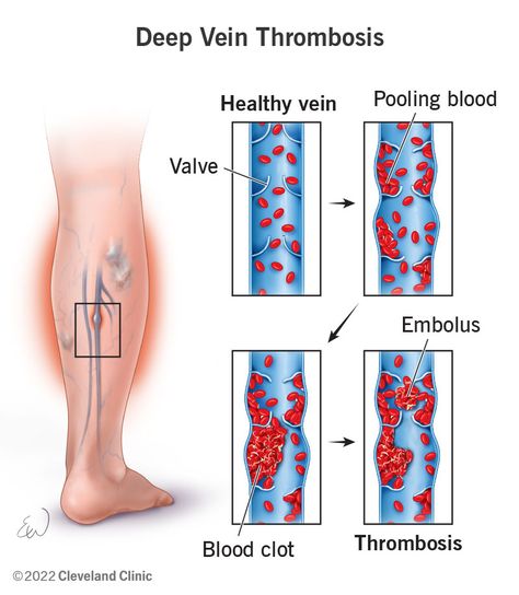 Central Venous Catheter, Fast Heartbeat, Leg Ulcers, Vein Thrombosis, Yoga Information, Venous Insufficiency, Feeling Dizzy, Nurse Aesthetic, Swollen Legs