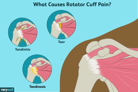 rotator cuff pain causes Torn Rotator Cuff Symptoms, Anatomy Spine, Rotator Cuff Rehab, Shoulder Muscle Pain, Rotator Cuff Pain, Shoulder Rehab Exercises, Exercise Therapy, Rehab Exercises, Shoulder Rehab