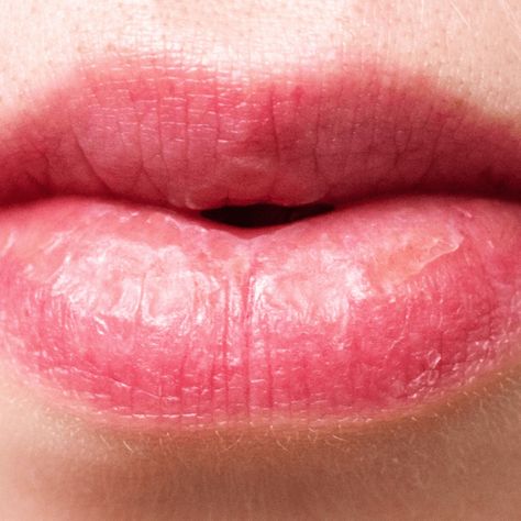 DIY Lip Balm To Revive Dry, Chapped Lips - Advice From Nobody Severe Chapped Lips, Chapped Lips Remedy Severe, Remedies For Chapped Lips, Chapped Lips Remedy, Lip Healing, Lip Tips, Lip Balm Recipes, Lip Care Routine, Diy Lip Balm