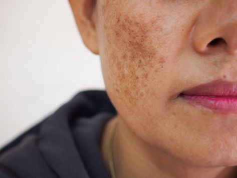 Is melasma the same as hyperpigmentation? Both of these terms are frequently used to describe skin conditions that result in dark patches of the skin, especially on the face. If you have dark patches on your skin that are bothersome, contact Buckhead Dermatology to schedule your appointment with our Atlanta-based, board-certified dermatologist today. Is melasma the same as hyperpigmentation? Find out more via our blog! Acne Overnight, Post Inflammatory Hyperpigmentation, Natural Acne Remedies, Dark Spots On Skin, Skin Specialist, Aesthetic Clinic, Skin Resurfacing, Skin Disorders, Acne Remedies