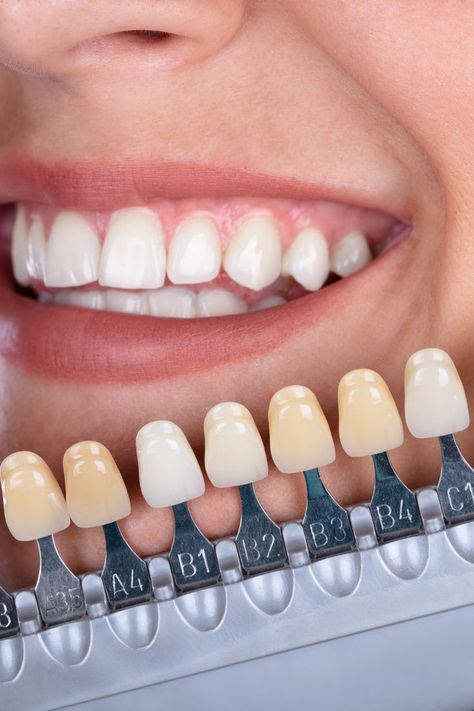 Whiten Your Teeth At Home, Teeth Whiting At Home, Dental Studio, Tooth Decay Remedies, Remedies For Tooth Ache, Whiten Your Teeth, Perfect Teeth, Teeth Health, Stronger Teeth