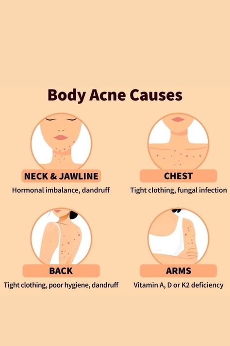 body acne causes, acne Bad Acne, Skin Advice, Clear Healthy Skin, Acne Skincare, Natural Face Skin Care, Natural Acne Remedies, Types Of Acne, Body Acne, Acne Causes