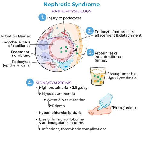 Nephrotic Syndrome Nephrotic syndromes are characterized damaged glomerular filtration membranes and high proteinuria. Review of the glomerulus and filtration membranes, physiologic roles in filtration. Glomerular Filtration Membrane Filtration membr Glomerular Filtration, Clinical Pathology, Nephrotic Syndrome, Med Surg, School Rules, Medical Illustration, Nursing School, Nursing, Disease