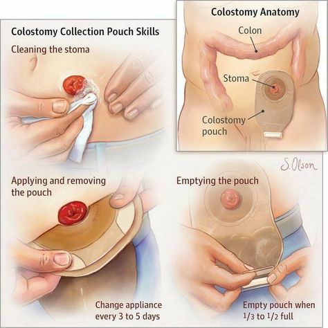 Nursing Ostomy Nursing, Wound Care Nursing, Ostomy Care, At The Doctor, Nursing School Essential, Nurse Study Notes, Nursing Student Tips, Surgical Nursing, Nursing School Tips