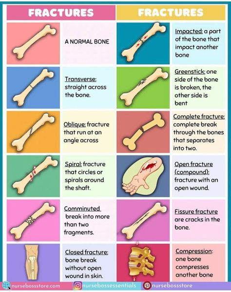 Basic Medical Knowledge, Sports Medicine Physician, Emt Notes, Nursing School Studying Cheat Sheets, Types Of Fractures, Medical Terminology Study, Medical Assistant Student, Nursing School Essential, Medical School Life