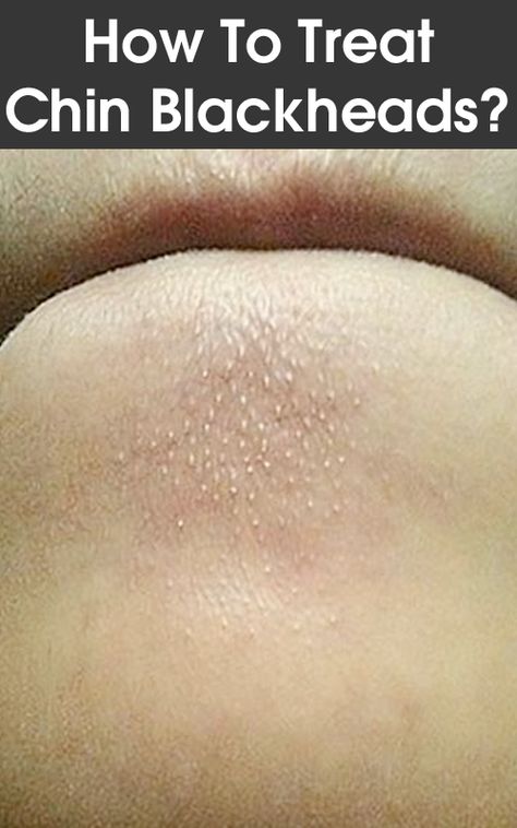 How To Treat Chin Blackheads? Chin Whiteheads, Chin Blackheads, Clear Blackheads, Black Heads, Get Rid Of Blackheads, Natural Cough Remedies, Beauty Remedies, Skin Tips, Facial Care