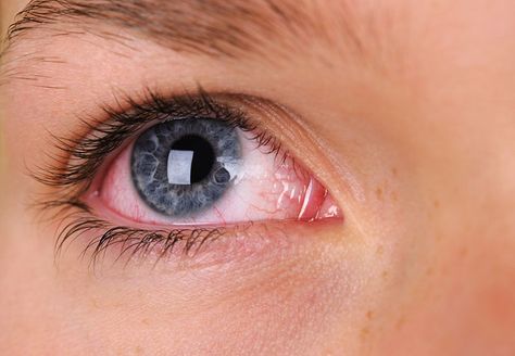 It seems like you always have red eyes, and people are starting to notice. Read more about the most common causes for red or bloodshot eyes and when you should see an eye doctor about them. What Causes Red Eyes, Blood Vessel In Eye, Eye Medicine, Elliot Smith, Dry Eyes Causes, Bloodshot Eyes, Eye Pain, Nasal Spray, Cleveland Clinic