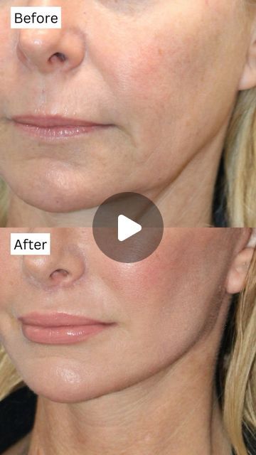 748K views · 22K likes | Amir M Karam, MD on Instagram: "I mean talk about a jaw dropping transformation! Wait until the end for a close up comparison of the jawline before and after. Truly so insane! Who wouldn’t kill for that jawline at any age 😂

She’s only two weeks out in these photos, and her incisions are still healing along with some other areas. But you can already see the architecture of her face has been restored to a beautiful youthful shape. 

At two weeks and 51 years old, she looks incredibly natural, just like her younger self.⁠
⁠
To achieve these incredible results, we performed: ⁠
✅Vertical Restore⁠
✅Custom Fat Transfer⁠
✅Lower Blepharoplasty⁠
✅Lip Lift⁠
✅@Karammdskin Trifecta for 6 months to address skin concerns prior to surgery⁠
.⁠
.⁠
.⁠
Let me know what you think and Still Healing, Old Photo Restoration, Lip Lift, Fat Transfer, Younger Self, Photo Restoration, Restoration Services, Cosmetic Surgery, Skin Concern