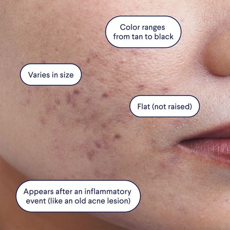 Post Inflammatory Hyperpigmentation Acne, Post Acne Hyperpigmentation, Scar Remedies, Post Inflammatory Hyperpigmentation, Treating Hyperpigmentation, Types Of Acne, Diy Facial, Acne Spots, Design Brochure