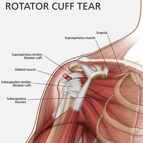 Rotator Cuff Injury : Physical Therapy and Surgery Rotator Cuff Strengthening, Supraspinatus Muscle, Subscapularis Muscle, Rotator Cuff Pain, Shoulder Anatomy, Rotator Cuff Exercises, Rotator Cuff Surgery, Shoulder Rehab, Shoulder Problem