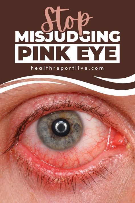 Here is a close up of a persons eye with the words stop missuding pink eye Viral Pink Eye Remedy, Pink Eye Remedies, Pink Eye Home Remedies, Pink Eye Remedy, Natural Pink Eye Remedy, Remedies For Dry Mouth, Pinkeye Remedies, Home Remedies For Allergies, Home Remedies For Warts