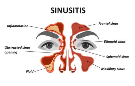 MARCoNS: Key Diagnosis or Moldy Folklore? Clogged Sinuses, Sinus Inflammation, Remedy For Sinus Congestion, Sinus Remedies, Home Remedies For Sinus, Maxillary Sinus, Sinus Congestion Relief, Chronic Sinusitis, Sinus Pain