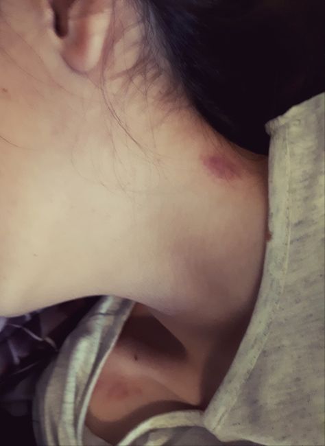 Love Bite Photos Aesthetic, Hickey Girls, Hickies Neck And Chest, Love Bites Mark Aesthetic, Love Bite Photos Real, Love Bite Snap, Hickey Mark, Neck Full Of Hickeys, Love Bite Photos