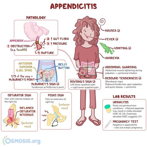 Osmosis on Instagram: “What are the most relevant differential diagnoses for appendicitis? Share your answers below. ⬇️ . Appendicitis is when the appendix gets…” Med Surg Gi Disorders, Decelerations Nursing, Pediatric Gi Disorders Nursing, Osmosis Nursing, Emt Worksheets, Advanced Emt, Emt Basic, Nursing Procedures, Hospital Medicine