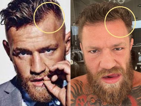 Conor McGregor Hairline Change Hair Transplant Results, Hair Transplant Surgery, Before After Photo, Conor Mcgregor, Hair Replacement, Hair Density, Hair Transplant, Technical Analysis, Celebrity Hairstyles