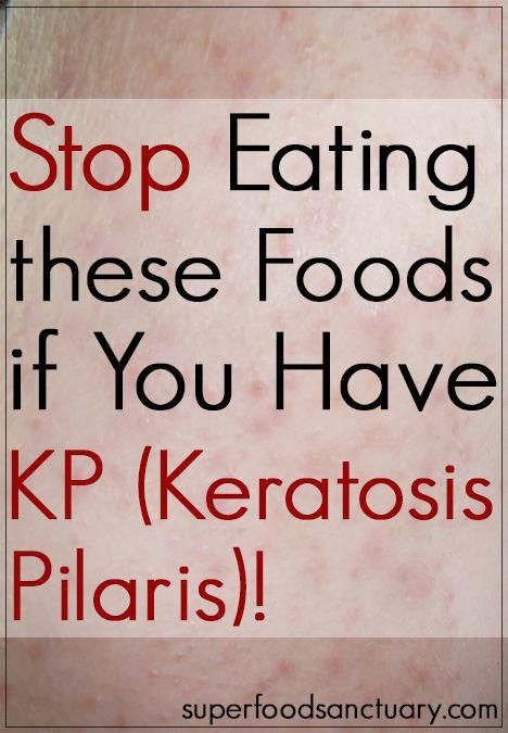 Keratosis pilaris (KP) is also known as ‘chicken skin.’ It mainly affects the upper arms, back of thighs, back of legs, buttocks, scalp and even the face. In this article, find out the list of foods to avoid if you have keratosis pilaris! Chicken Skin Remedy, Keratosis Pilaris On Face, Coffee Facial, Strawberry Legs, List Of Foods, Glowing Radiant Skin, Skin Bumps, Keratosis Pilaris, Bumpy Skin