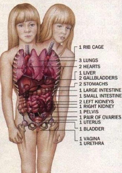 Their Internal Organs Are A Un... is listed (or ranked) 2 on the list 15 Things Most People Don't Know About Conjoined Twins Abby And Brittany Human Oddities, Conjoined Twins, Internal Organs, Medical Anatomy, Large Intestine, Summer Wedding Outfit Guest, Gambar Figur, Body Anatomy, The Human Body