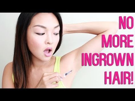 HOW TO: Get Rid of Ingrown Hairs